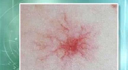 肝脏|身体出现这种“肉痣”，可能是肝脏的“呼救信号”，尽量别忽视