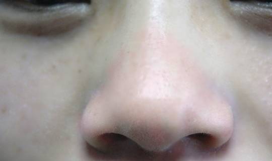 治疗|身上多处长“小红点”,可别不当回事,或是肝脏病变的信号