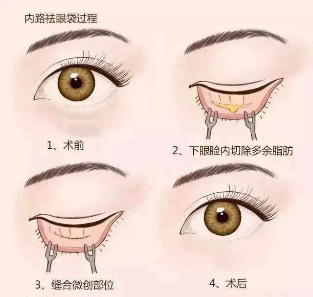眼袋|外切、内切还是激光，小小眼袋到底怎么切？