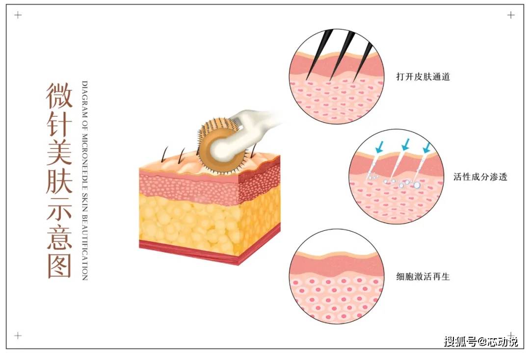 疗法|“微针疗法”到底是什么？关于这4点一定要了解清楚