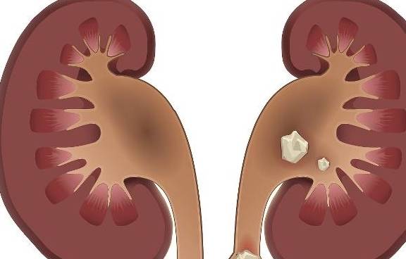零点|肾结石如果不痛，就不用理睬？这2个危害可不小