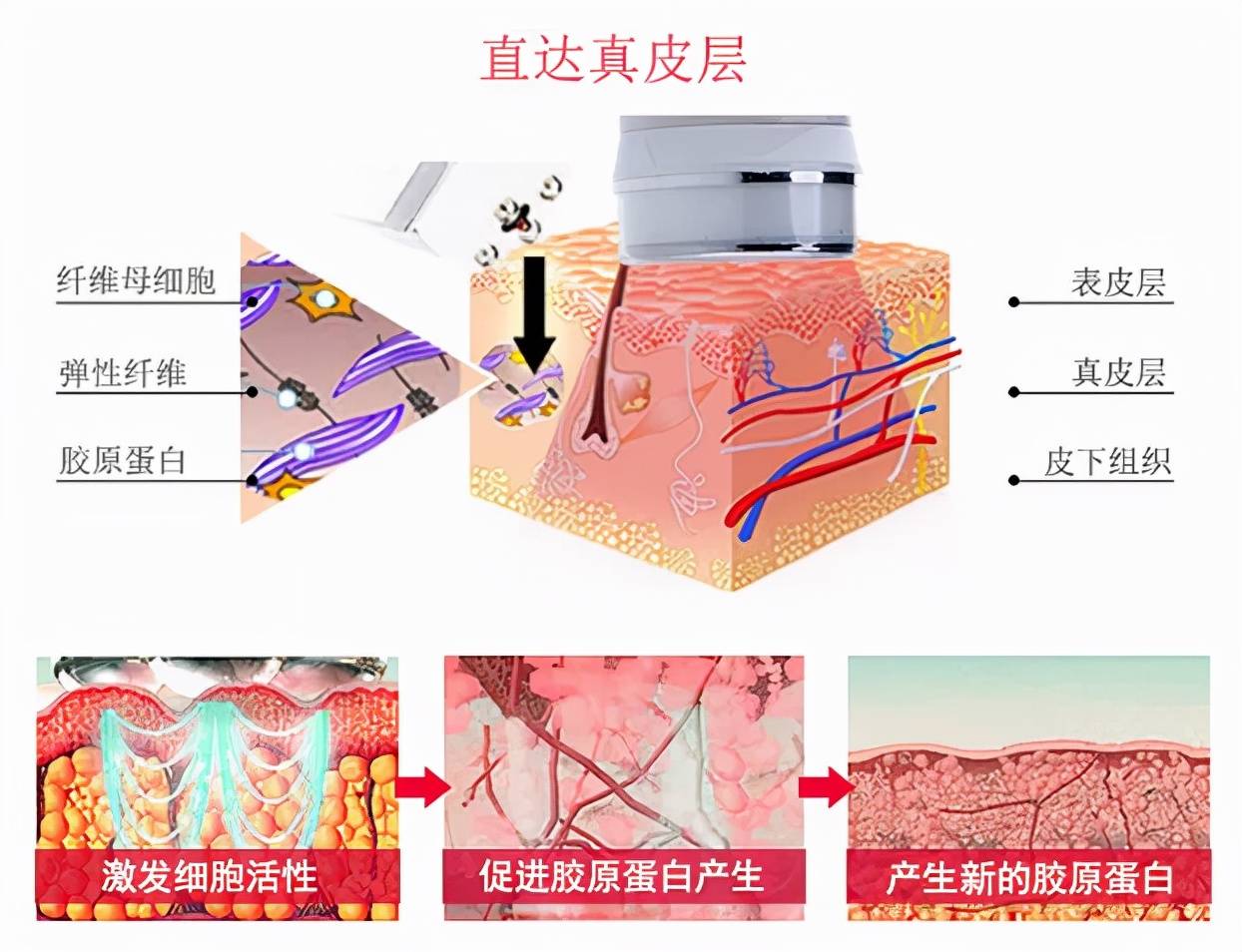 王艳|王艳医生美容科普：光子嫩肤适应症？