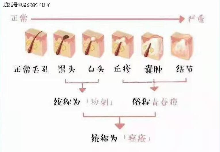 过段时间|男士护肤：皮肤长痘应该怎么护肤？