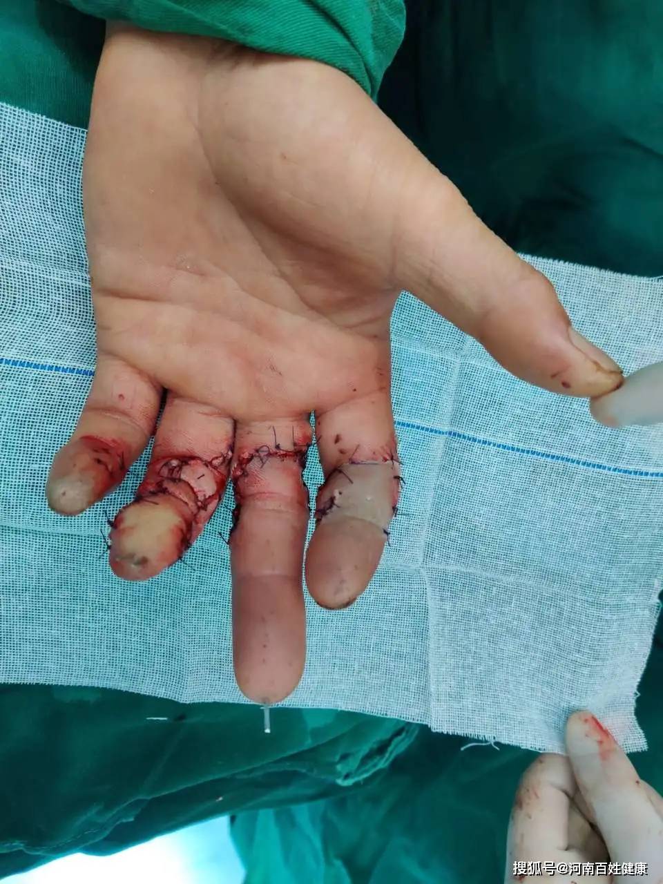 惊魂电锯切掉3根手指医生奋战十小时