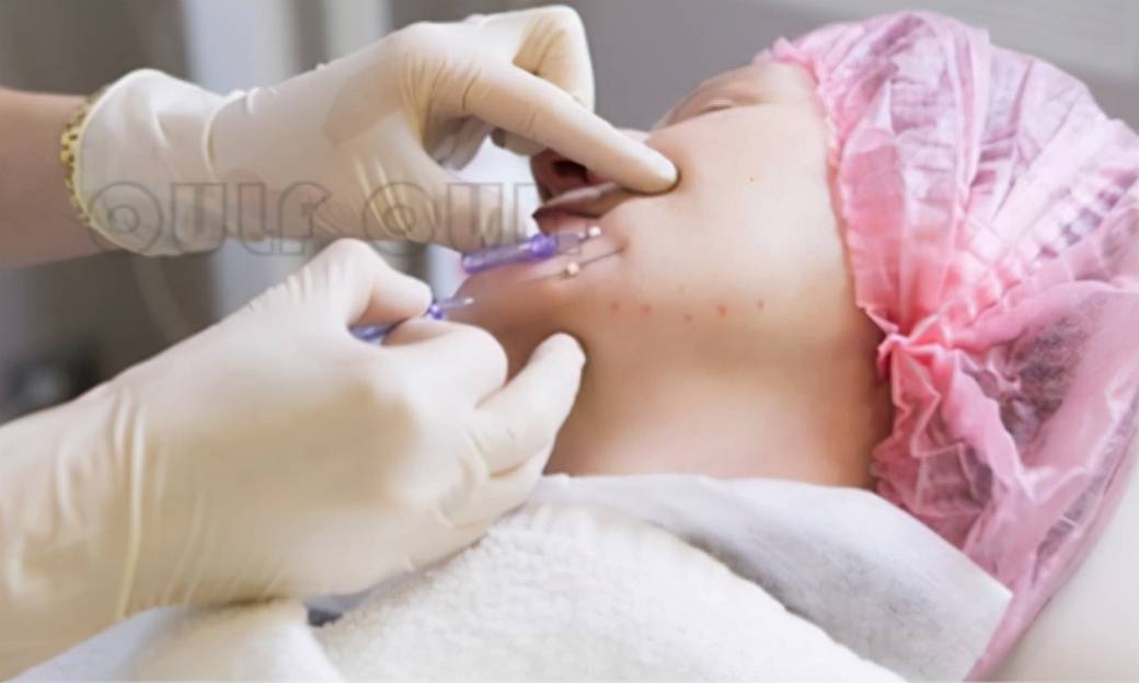 吓人线雕断线后有什么症状哪些人不适合做线雕一起来康康