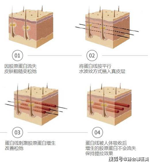 咨询|线雕隆鼻3个月，线体穿出了！你们真的还要做吗？(1)