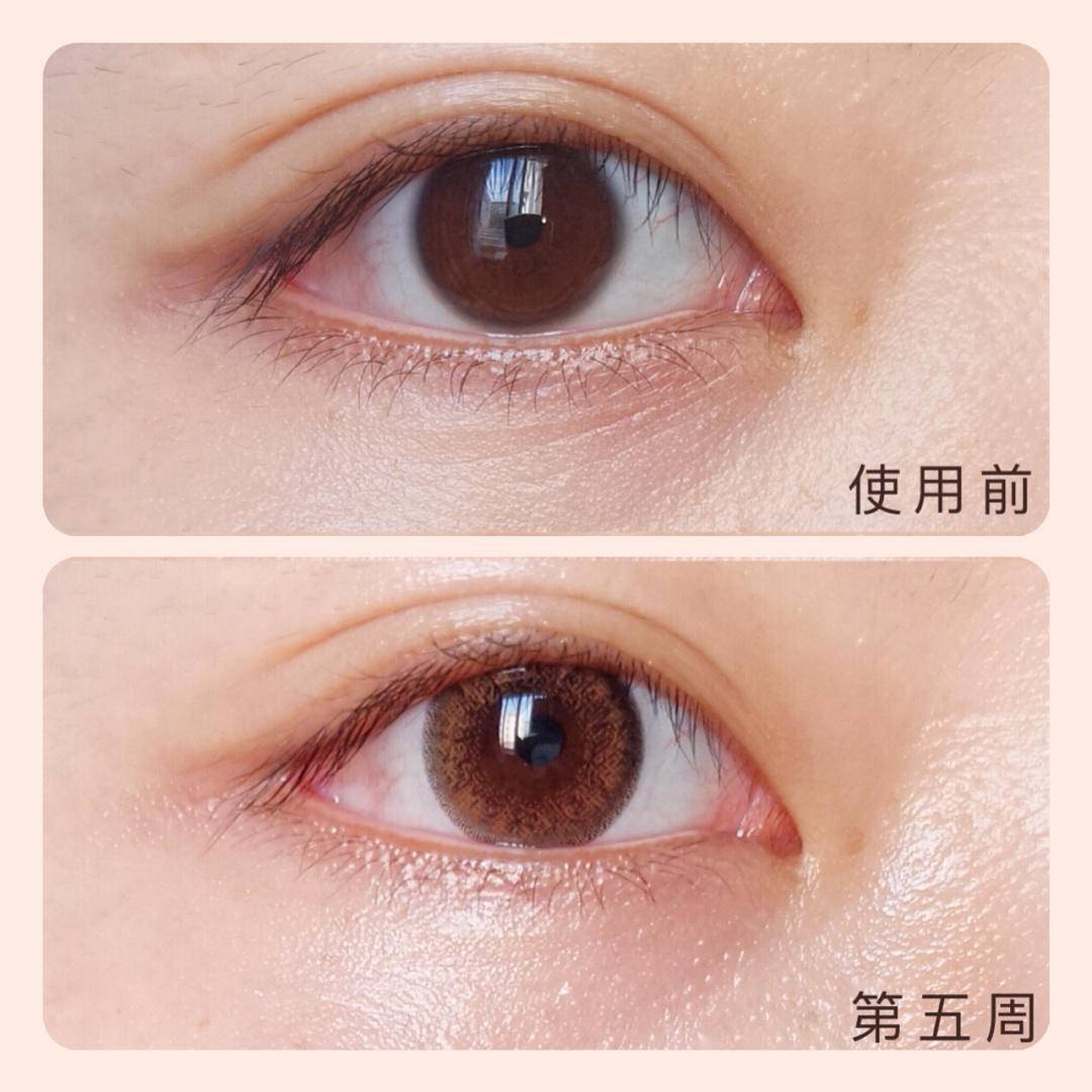 眼睛|眼膜真的有用吗？眼睛上的细纹有救了！