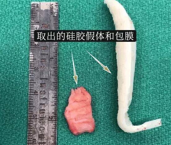 人体|一次搞懂！鼻整形人工材料选择攻略~