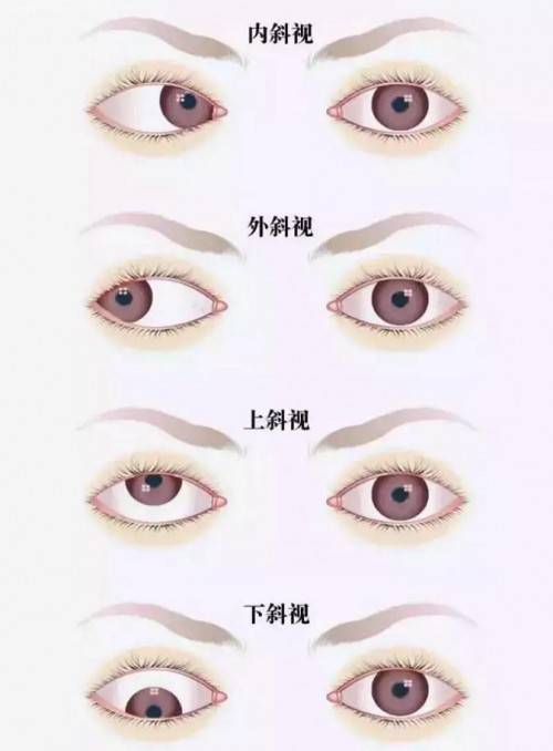 成都爱尔开学季斜视视力检查刻不容缓