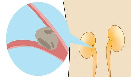 毒素|出现肾结石,身上会有哪些表现?哪些坏习惯最招肾结石?要重视