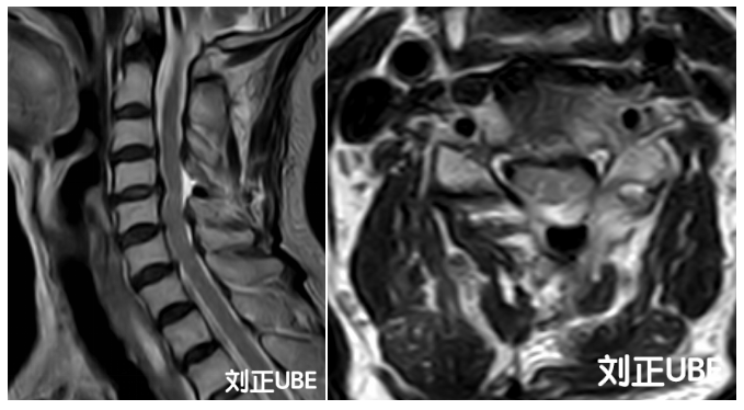技术|颈椎问题，微创帮您解除困扰！