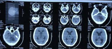 进行|用哪种方法确诊重症肌无力呢？重症肌无力如何治疗？