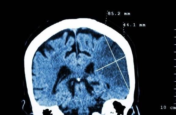 同学|CT查出“腔隙性脑梗死”，医生说不用太担心，这是个什么病呢？