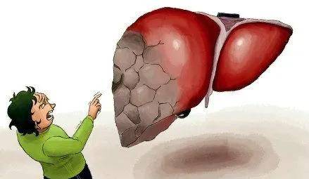 什么|什么是肝腹水？肝腹水的初期症状有哪些？