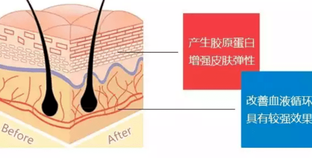 眼袋|蛋白线埋线去眼袋图片？吓人！