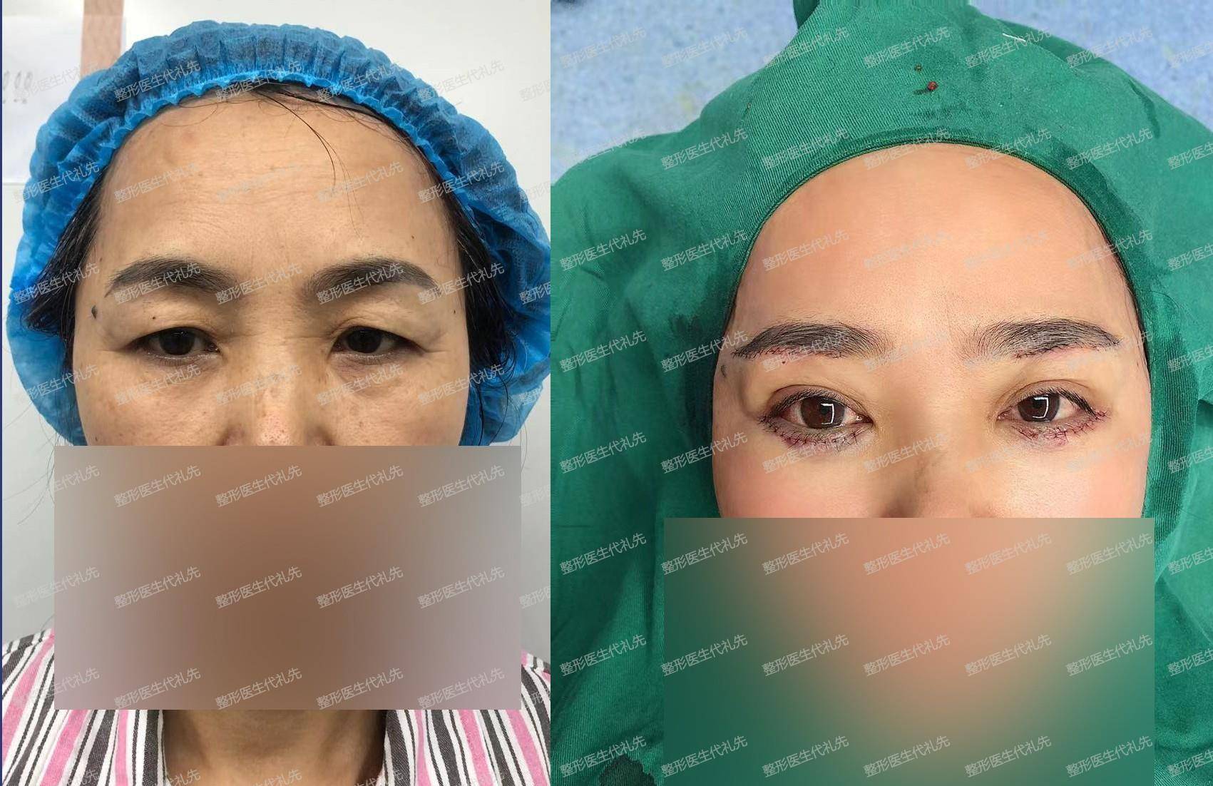 进行总结提眉手术大家问得最多的20个问题，一起来看看