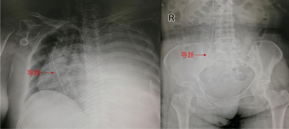 血栓|寻找50cm长脱落于下腔静脉的导丝