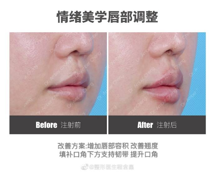 下唇你的唇形符合美学标准么 杭市一程含皛医生谈丰唇术
