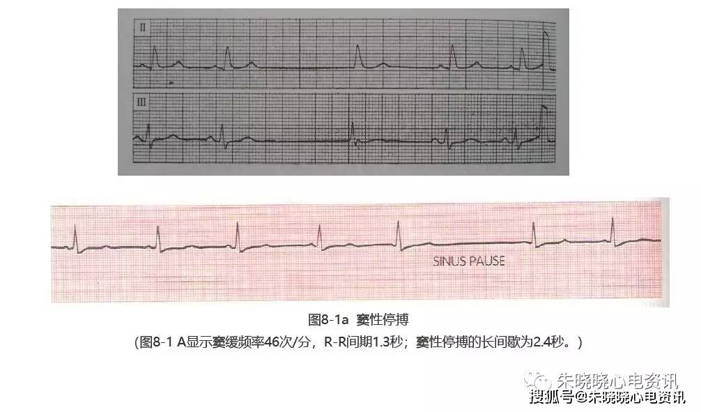 臨床實用心電圖入門第八講病態竇房結綜合症