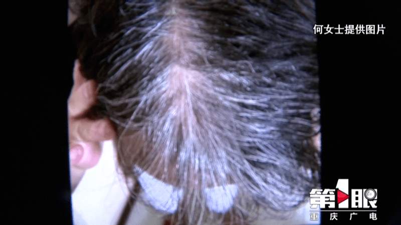 网友|女子花4万做“白发转黑”，结果治疗就是拔了白发