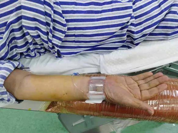 血管|北京老年医院成功完成经桡动脉入路椎动脉狭窄支架置入术