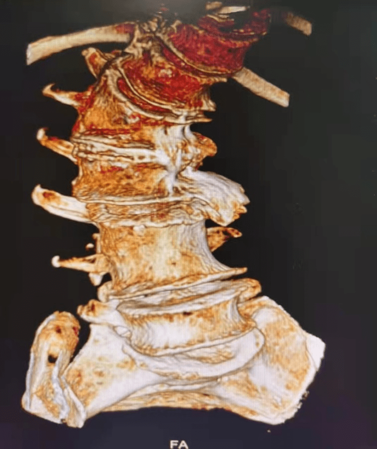 手术|腰疼40年，腰椎侧弯70度，不开刀能治好吗？