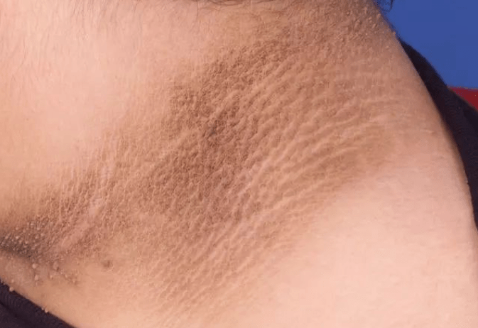 血液|血糖“清洁剂”找到，不是洋葱！这种“零食”紧着吃，高血糖或会降低