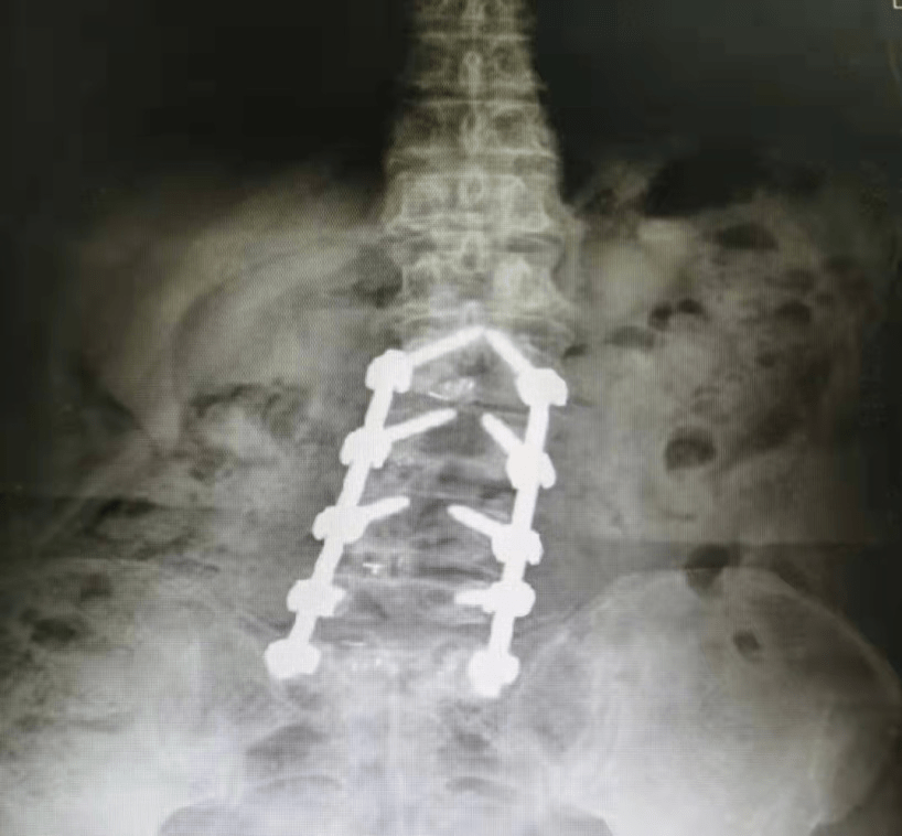 手术|腰疼40年，腰椎侧弯70度，不开刀能治好吗？