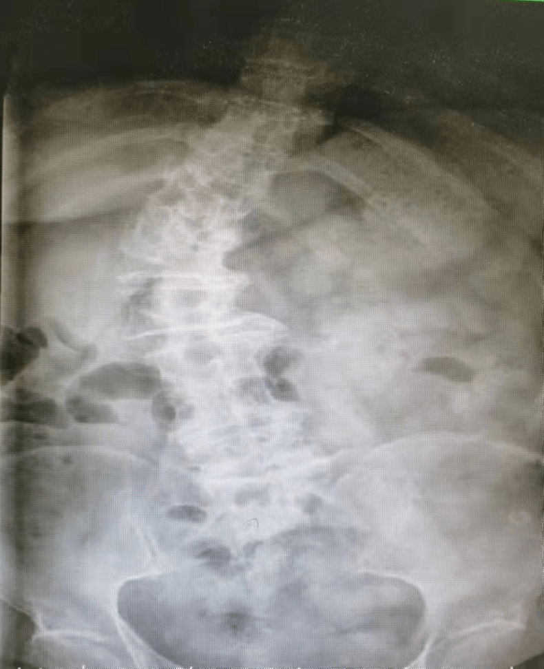 手术|腰疼40年，腰椎侧弯70度，不开刀能治好吗？