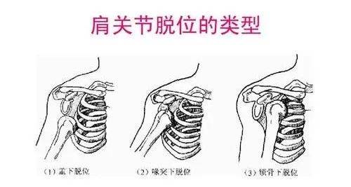 肩周炎痛是什么原理_肩周炎是哪个部位痛图(2)