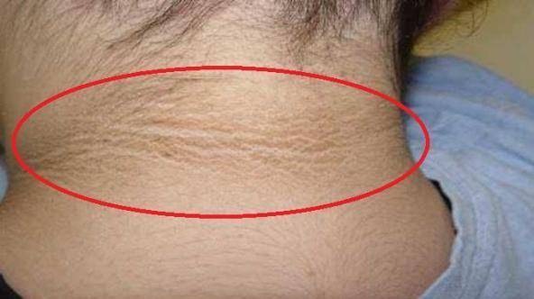 控制|皮肤是血糖的“晴雨表”，皮肤有4种表现，就是让你控糖的信号