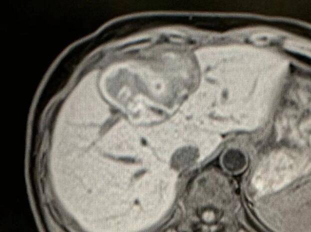 癌症|湖北肿瘤医院选择广州复大肿瘤医院：肝癌患者致谢复大