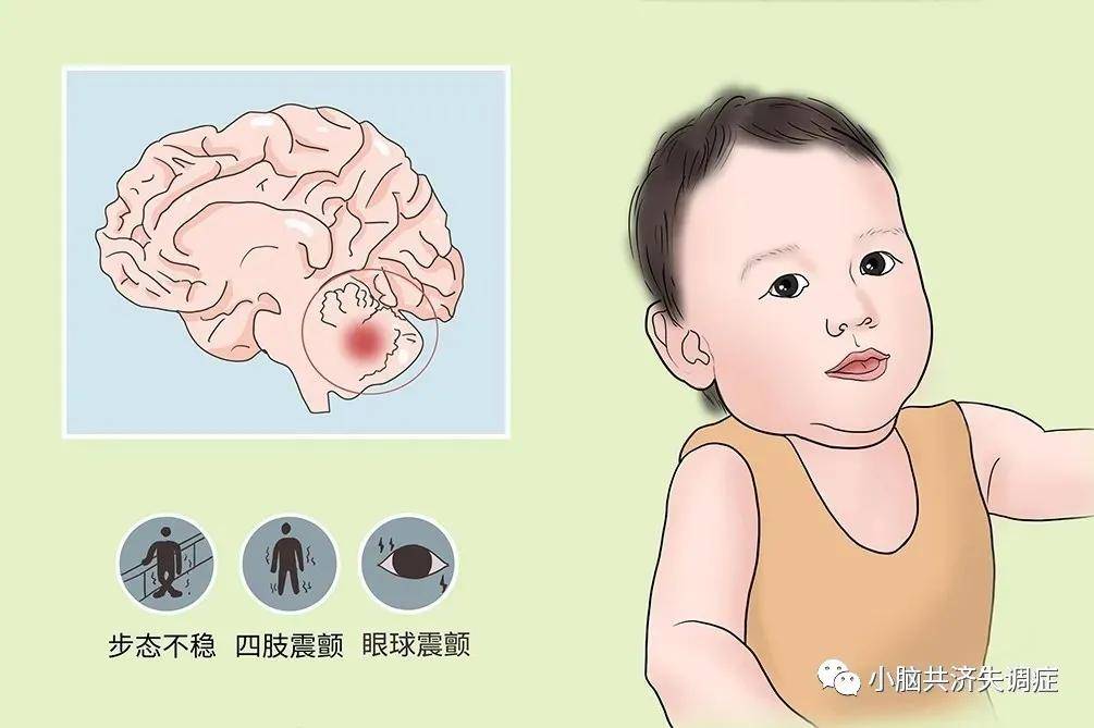小孩|小孩共濟失調有什么表現，有三個癥狀警惕是共濟失調