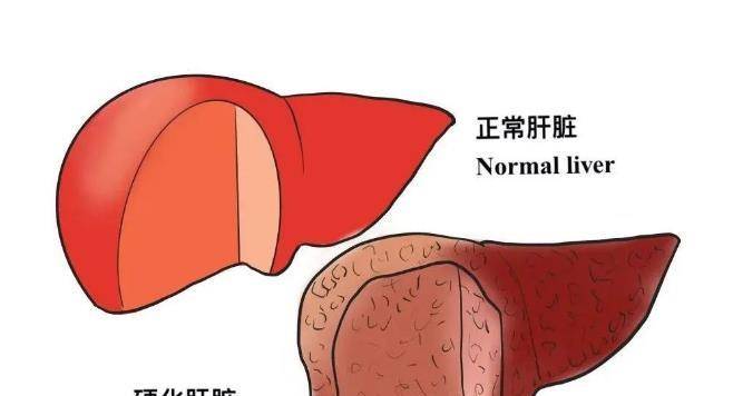 肝脏|肝纤维化是什么？是否可以逆转？