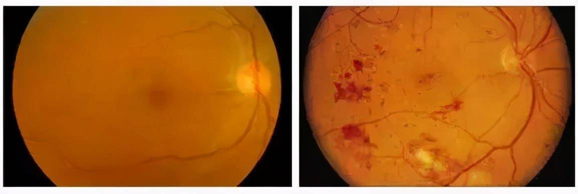 控制|血糖超过多少需要用药物来控制？长期血糖超高，有哪些危害？