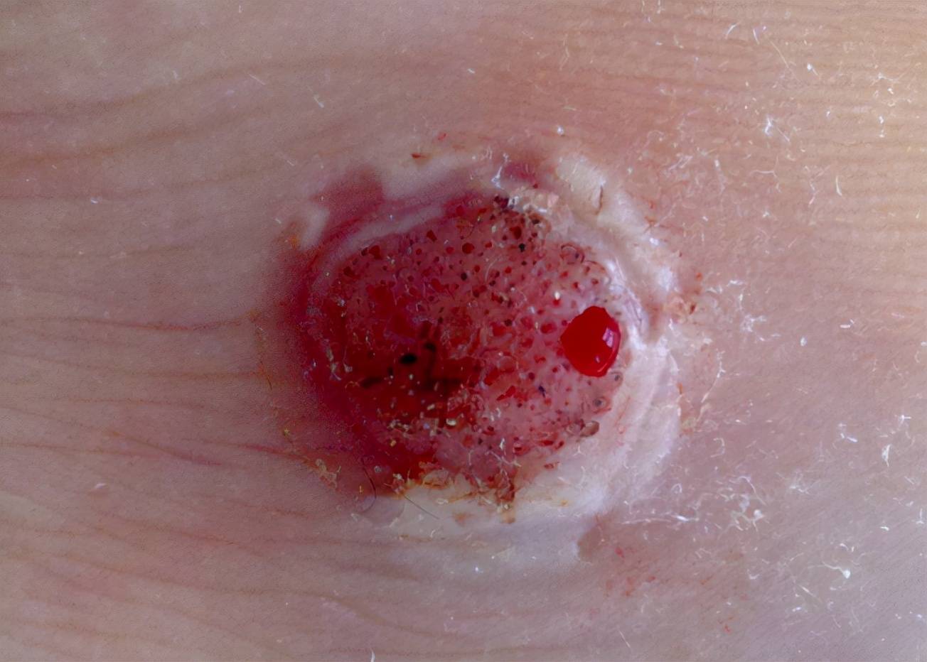 感染hpv病毒也不要惊慌,清除病毒,做好一件事就够了!