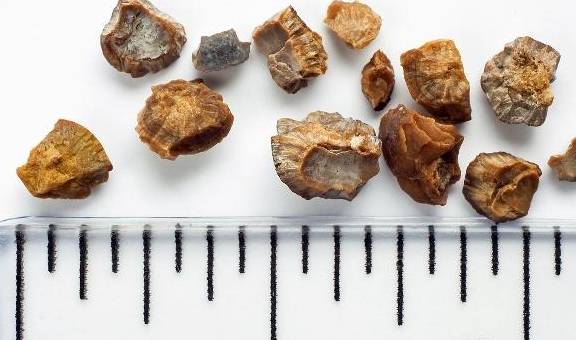 肾脏|肾结石是“吃”出来的?这种食物可能有助于排出结石,别错过!