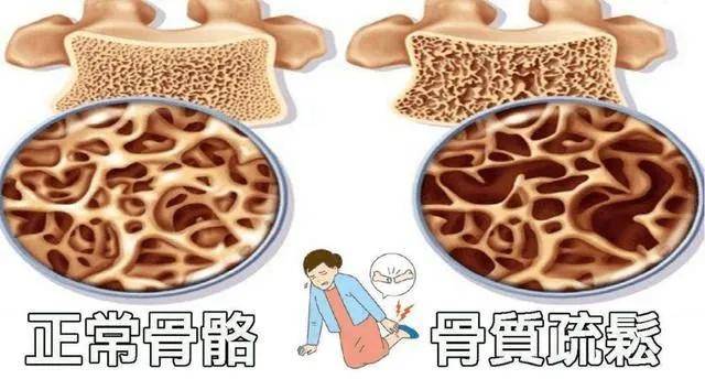 骨质疏松多长时间能补上来 5a6143bc459841c1bacbb31da11c6f71.jpeg