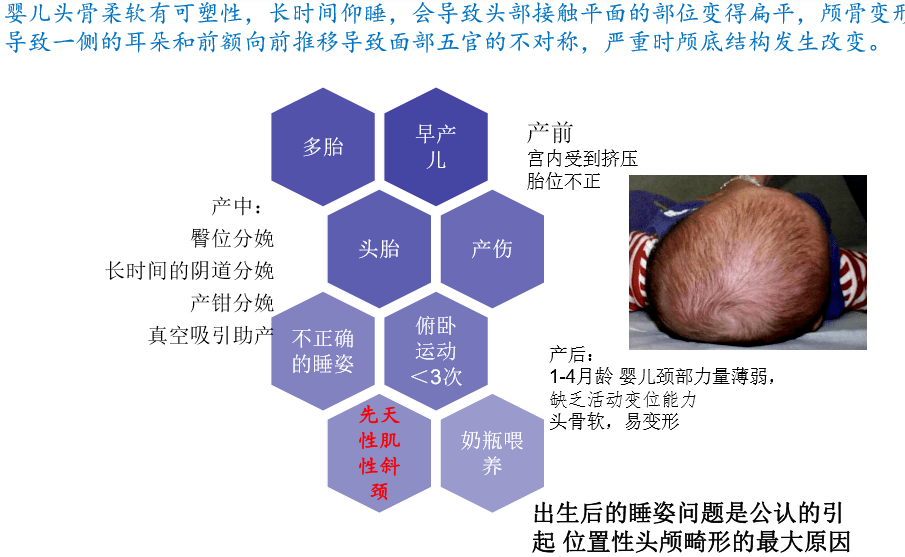 头颅畸形舟状头