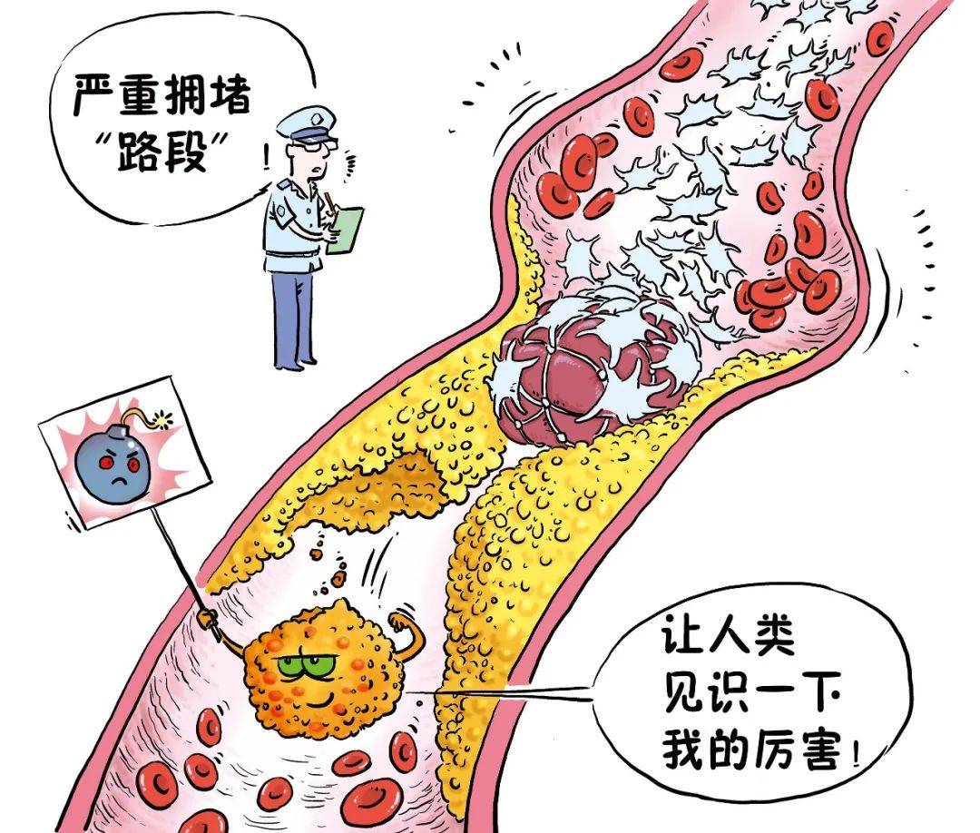 血栓和斑块的区别图片