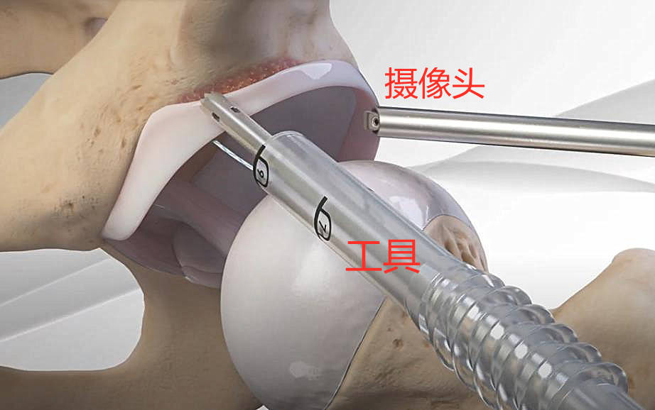 人工髋关节置换该换一个金属的陶瓷的还是塑料的
