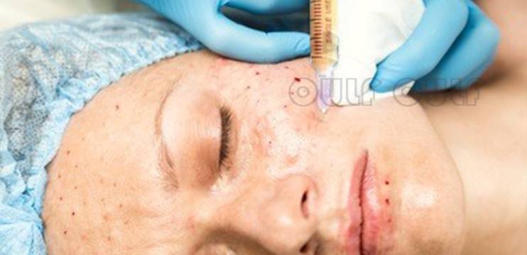 进行暨大细胞激活填充安全吗？我见识短！