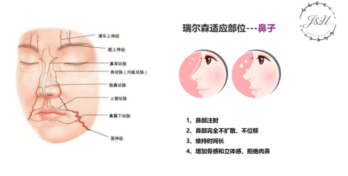 进行液态膨体 | 非术俏鼻精雕专属可降解骨性填充塑形材料