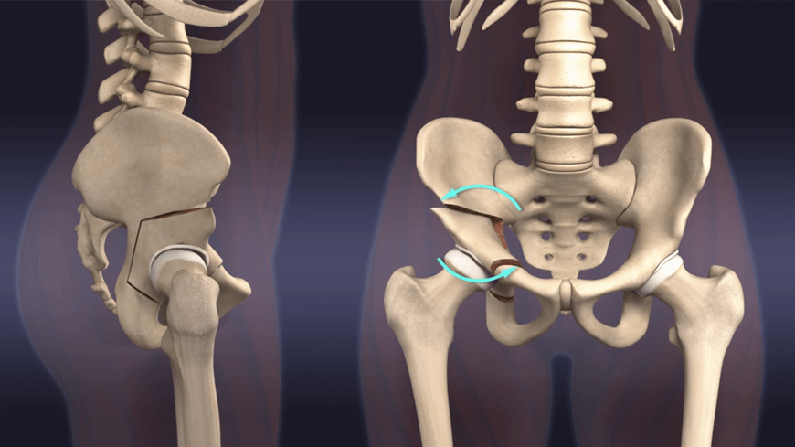 时间|20到50岁，不想做人工髋关节置换，保髋手术能撑多久？
