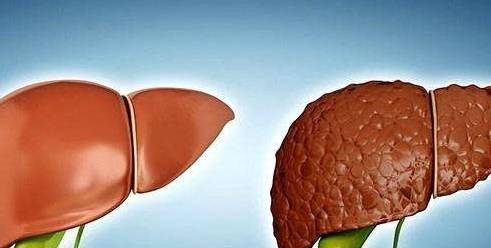 肝脏|常做这3件事，可能成为肝硬化“加速器”，希望你一个也没占