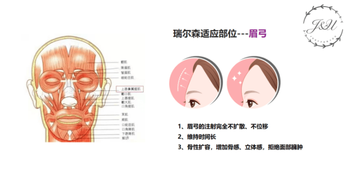 进行液态膨体 | 非术俏鼻精雕专属可降解骨性填充塑形材料