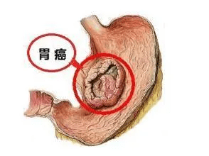 症状|院士提醒“久拖成癌”的5种疾病，生活中极易忽略，当心后悔莫及