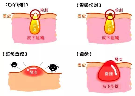 毛孔易烊千玺因脸上长痘在线撒娇