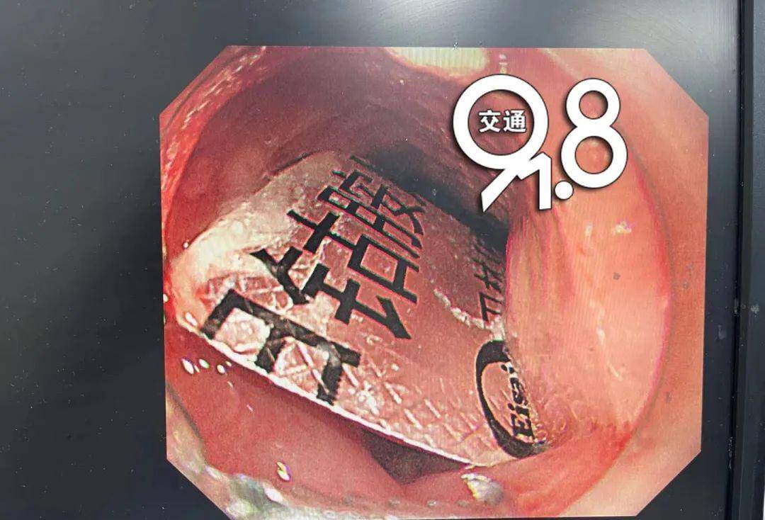 带着|九旬阿婆吃药被卡，竟从胃里掏出了带着完整铝箔外包装的药片