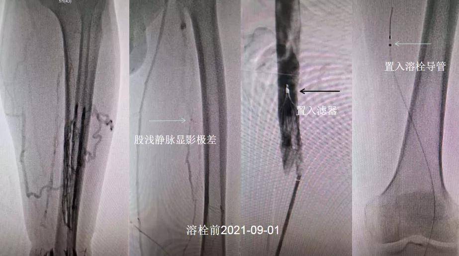 杀手|“沉默的杀手”——深静脉血栓（DVT）